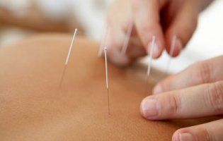 Точковий масаж та голковколювання
