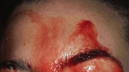 Італійські лікарі розповіли про дівчину, яка «потіє кров'ю»