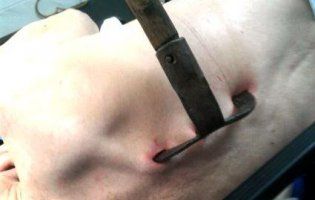 На Волині у спину жінки встромили копачку (фото 18+)