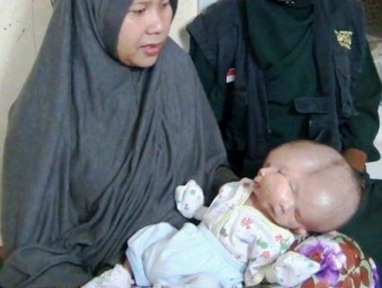 В Індонезії народилася дитина з двома обличчями та мозками