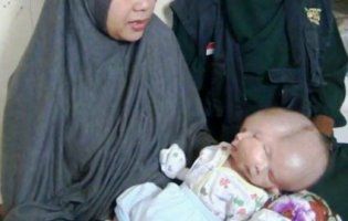 В Індонезії народилася дитина з двома обличчями та мозками