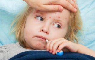 У Львові щодоби з кором госпіталізують 30 осіб: чим небезпечна нова хвиля