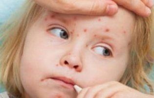 Кількість хворих на кір в Україні збільшилося майже у 20 разів