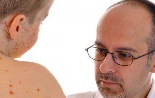 Від кору в Україні вже померло 11 дітей