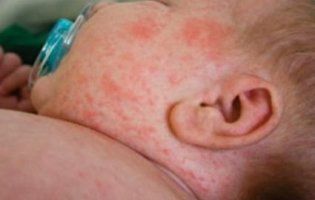 МОЗ оголосило спецоперацію зі щеплення населення проти кору