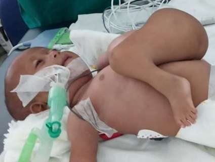 В Індії хірурги відтяли близнюка-паразита, який пожирав немовля (фото)