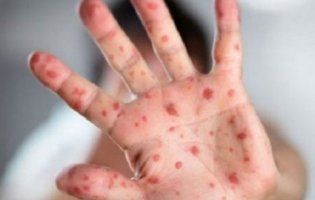 26 хворих дітей за добу: в селі на Одещині спалах кору