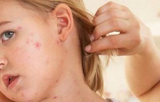 Цього року від кору померли 5 осіб, троє з них — минулого тижня