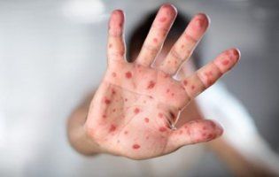 В Україні можуть оголосити епідемію кору