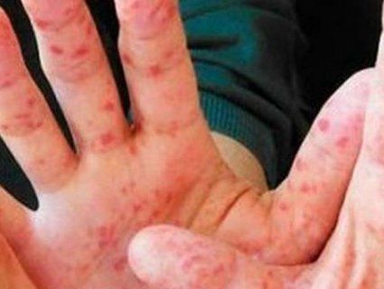 10 хворих на день: близько 300 військових захворіли на кір