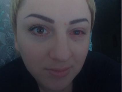 На Черкащині жінка осліпла на одне око після татуажу повік (відео)