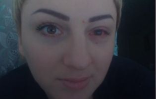 На Черкащині жінка осліпла на одне око після татуажу повік (відео)