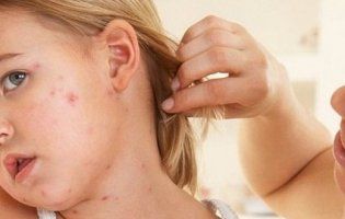 Щеплення від кору: як дізнатися, чи воно вам потрібне (відео)