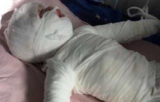 Скупала в окропі: під Одесою мати «обварила» 11-місячного малюка (фото)