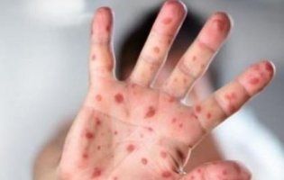 В Україні на кір захворіли ще понад 2 тисячі людей