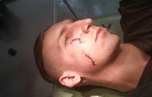 Нічне патрулювання: у Луцьку почикрижили лице самооборонівцю (фото)