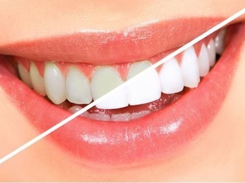 Неочікувано: чим загрожує безневинна процедура у стоматолога
