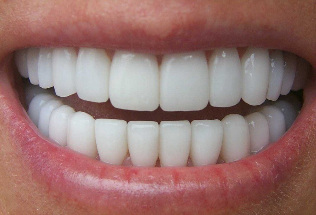 Відбілювання зубів: розвінчано головні міфи