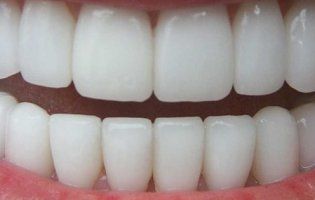 Відбілювання зубів: розвінчано головні міфи