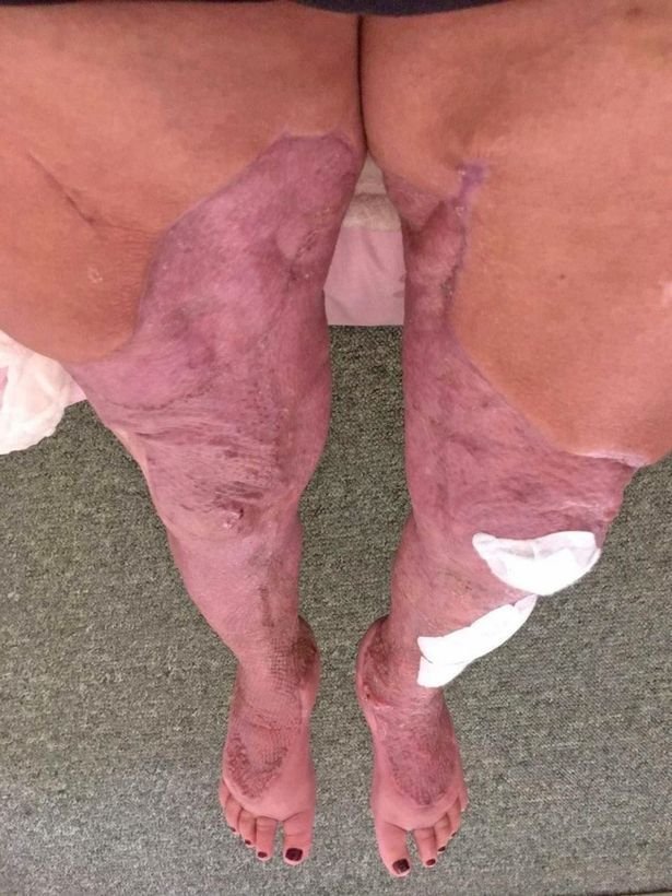 Ноги Джейні Насіменто після операції