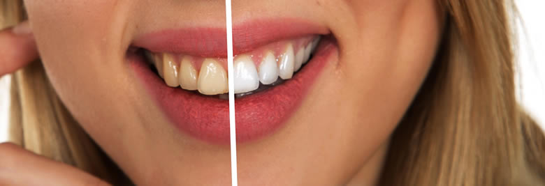 Методи відбілювання зубів