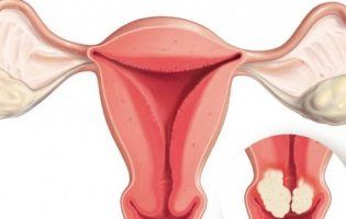 Рак шийки матки – симптоми, діагностика та лікування