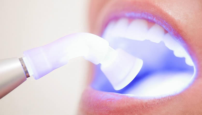 Відбілювання зубів лазером