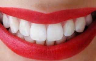 Способи відбілювання зубів
