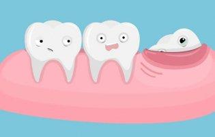 Зуби мудрості: видалити не можна залишити