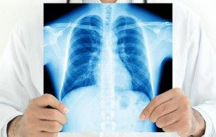 Чи будуть хворі на туберкульоз заражати всіх здорових?