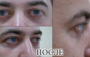 Блефаропластика — лазерная или хирургическая