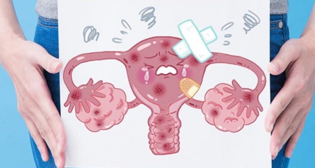 ПАП-тест – шанс виявити рак шийки матки на нульовій стадії