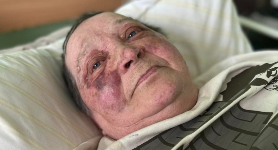 У Херсоні росіяни зламали хребет 70-річній волонтерці