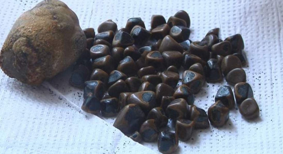 На Волині лікарі видалили жінці 81 камінь з жовчного міхура