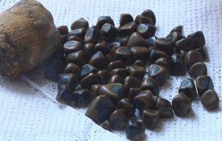 На Волині лікарі видалили жінці 81 камінь з жовчного міхура