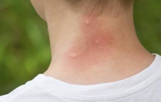 На Волині зростає кількість хворих через укуси мошок