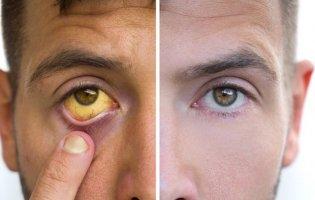 У громаді на Волині виявили хворого на гепатит А