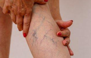 Чому виникає судинна сіточка і чи можна кремом її вилікувати?