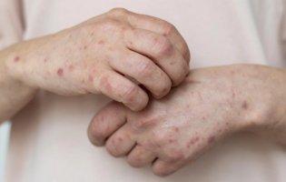 На Волині з початку 2025-го чотири людини захворіли на кір