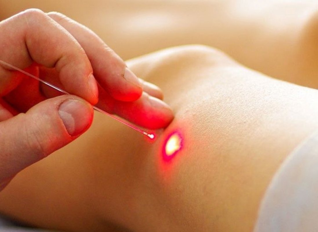 Куди в Києві звернутися для лазерного видалення вен?