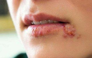 Цим вірусом заражені більше від половини людей на планеті!