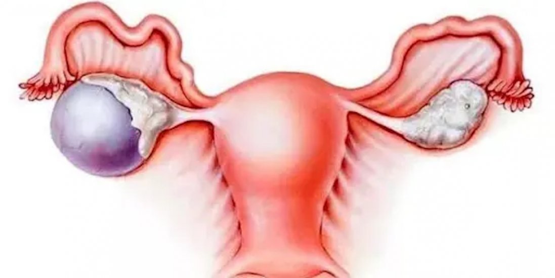 Чому виникають кісти, як їх вилікувати і чи справді вони «помолодшали»