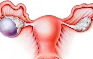 Чому виникають кісти, як їх вилікувати і чи справді вони «помолодшали»