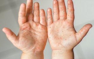 Українців атакує новий вірус: схожий на герпес і провокує розлади травлення