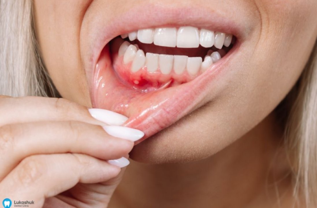 Чому важливо не ігнорувати симптоми проблем з яснами