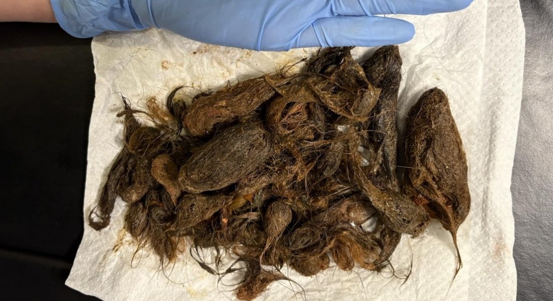 У Луцьку зі шлунка дитини витягли 700 грамів волосся