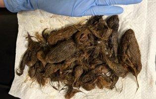 У Луцьку зі шлунка дитини витягли 700 грамів волосся