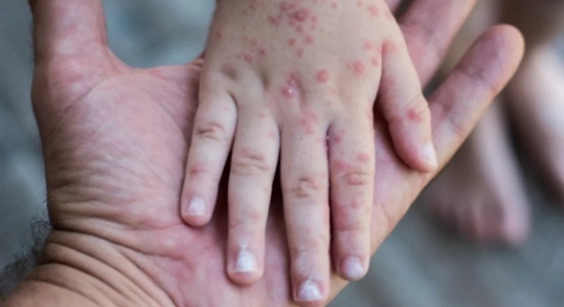 Українців атакує новий вірус: схожий на герпес і провокує розлади травлення