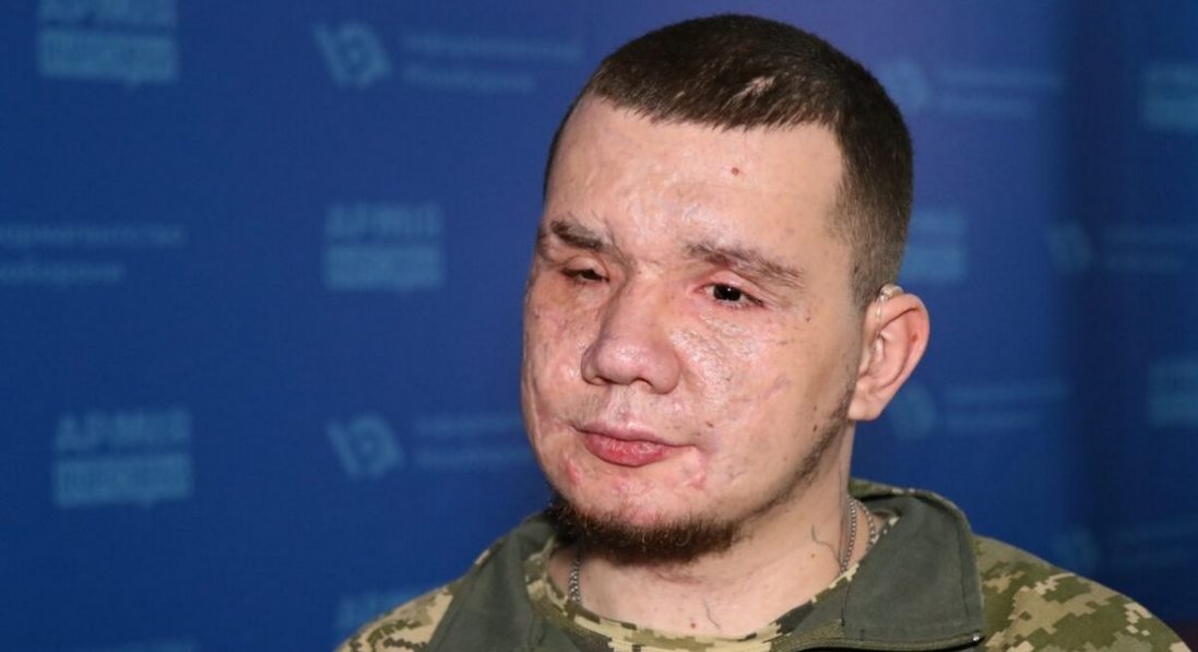 Утратив на фронті зір та слух: такою стала ціна 84 урятованих життів