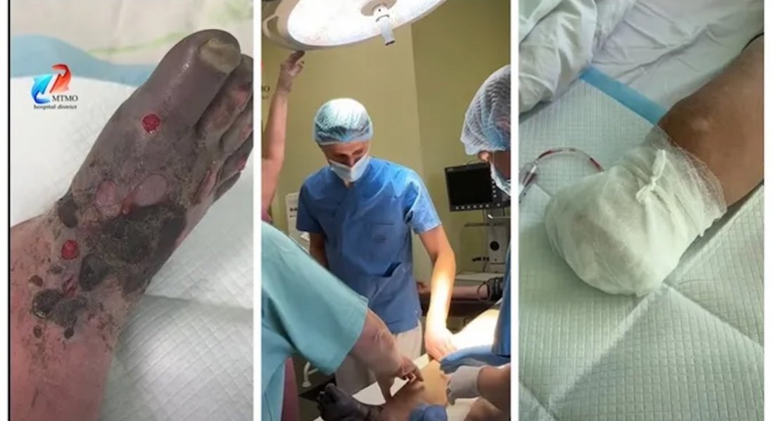 У Ковелі чоловіку ампутували обморожену ногу